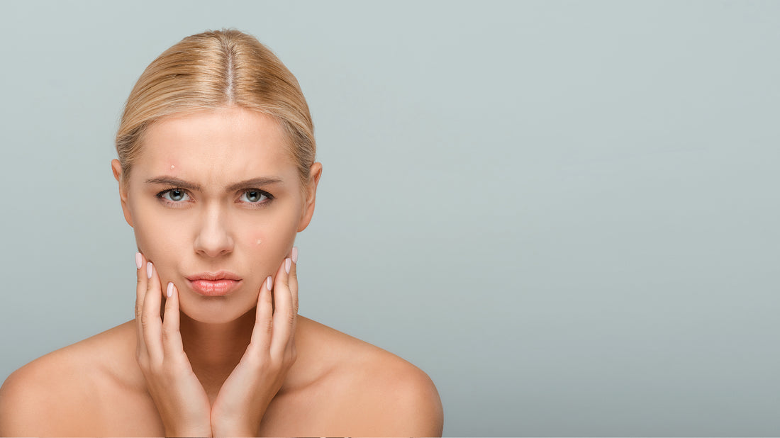 What is skin purging?